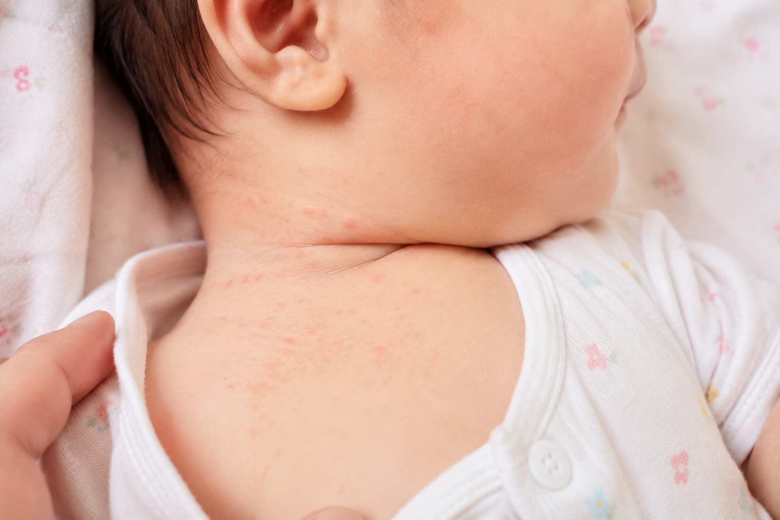 A Complete Guide to Managing Newborn Heat Rash:
From Symptoms and Causes to Effective Care tactics
